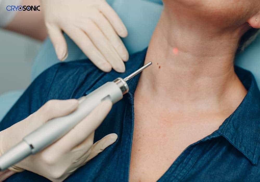 How CryoPen Differs from Apple Cider Vinegar