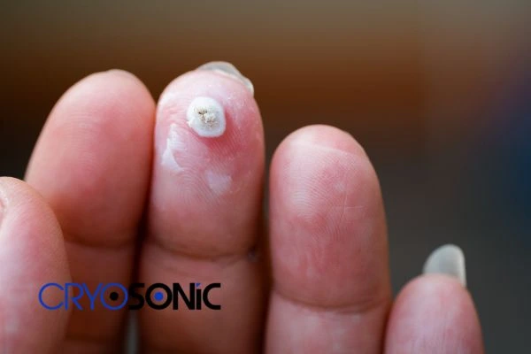 Cryotherapy being used to remove plantar warts