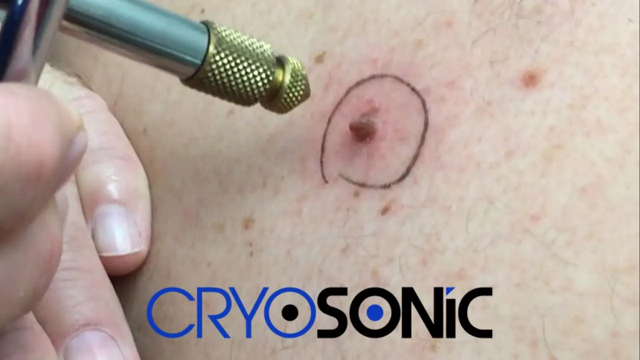 What Happens When A Mole Or Skin Tag Gets Frozen Off With Liquid Nitrogen