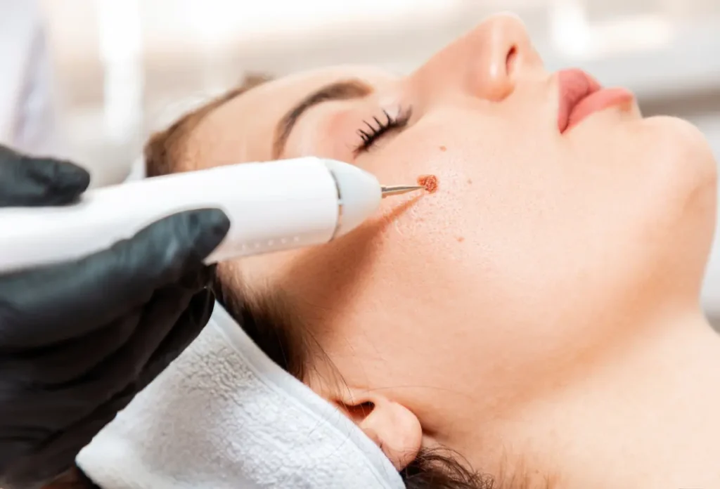 Guidelines for Avoiding Cherry Angiomas