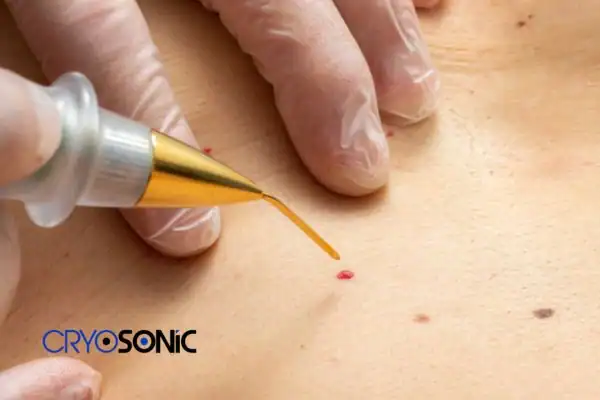What are the contributing causes of cherry angiomas?